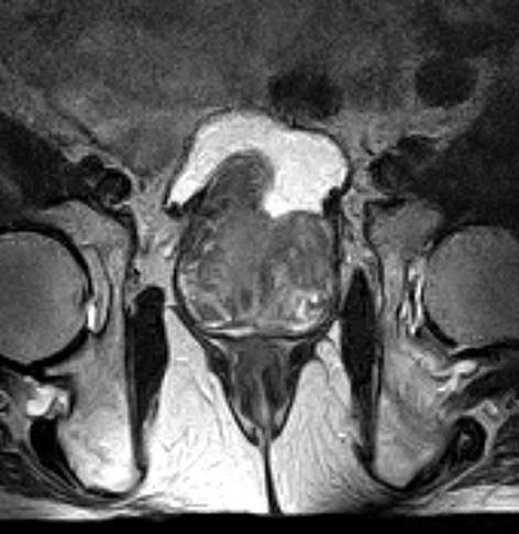Prostate Coronal MRI scan